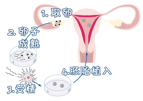 借卵代孕一站式服务